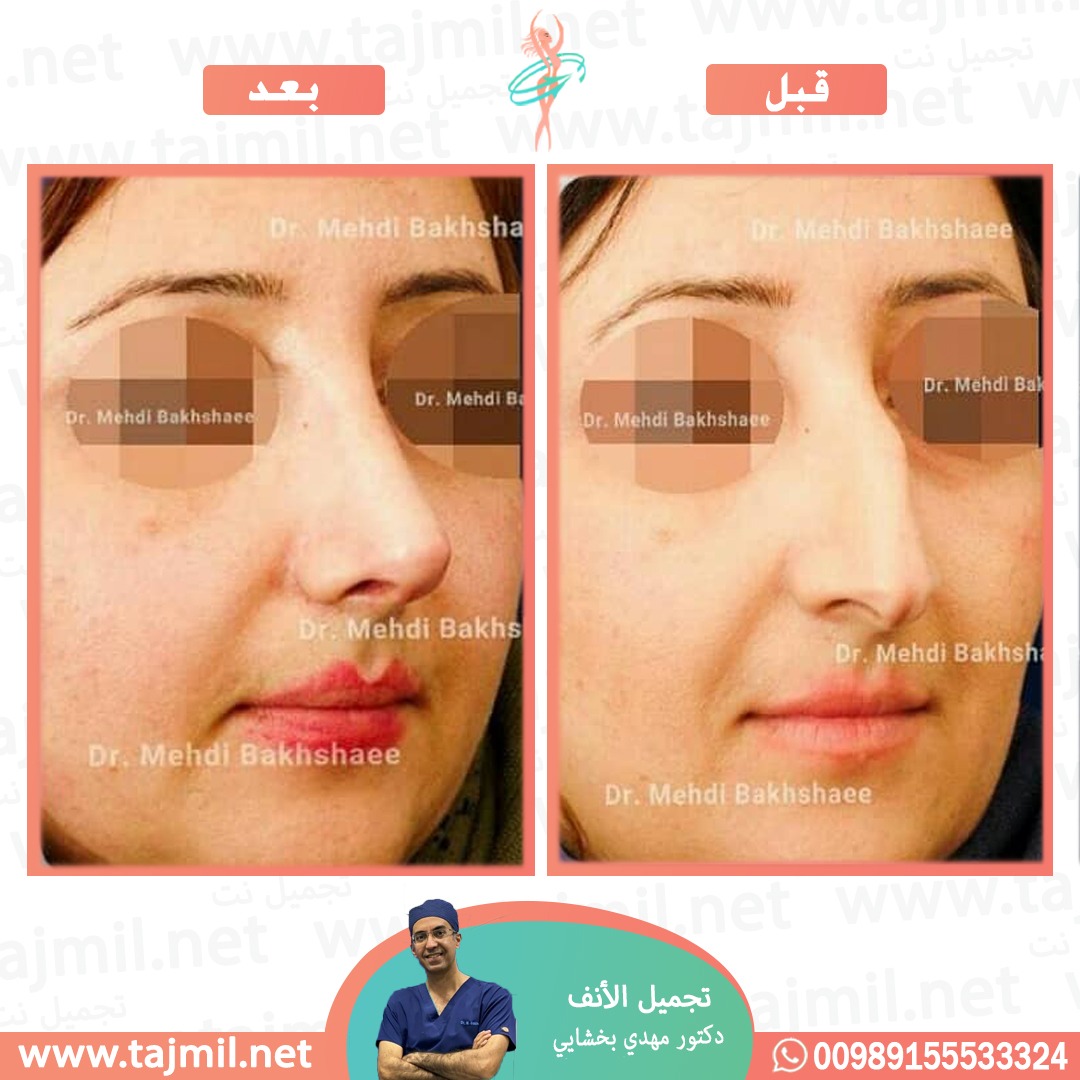  - دکتور مهدي بخشایي عملية تجميل الانف في ايران مع تجميل نت