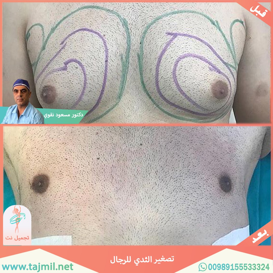  - دکتور مسعود نقوي عملية تصغیر الثدي للرجال في ايران مع تجميل نت