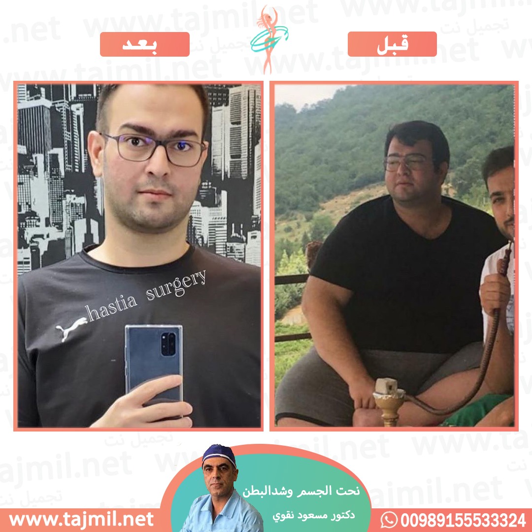  - دکتور مسعود نقوي عملية نحت الجسم و شد البطن في ايران مع تجميل نت