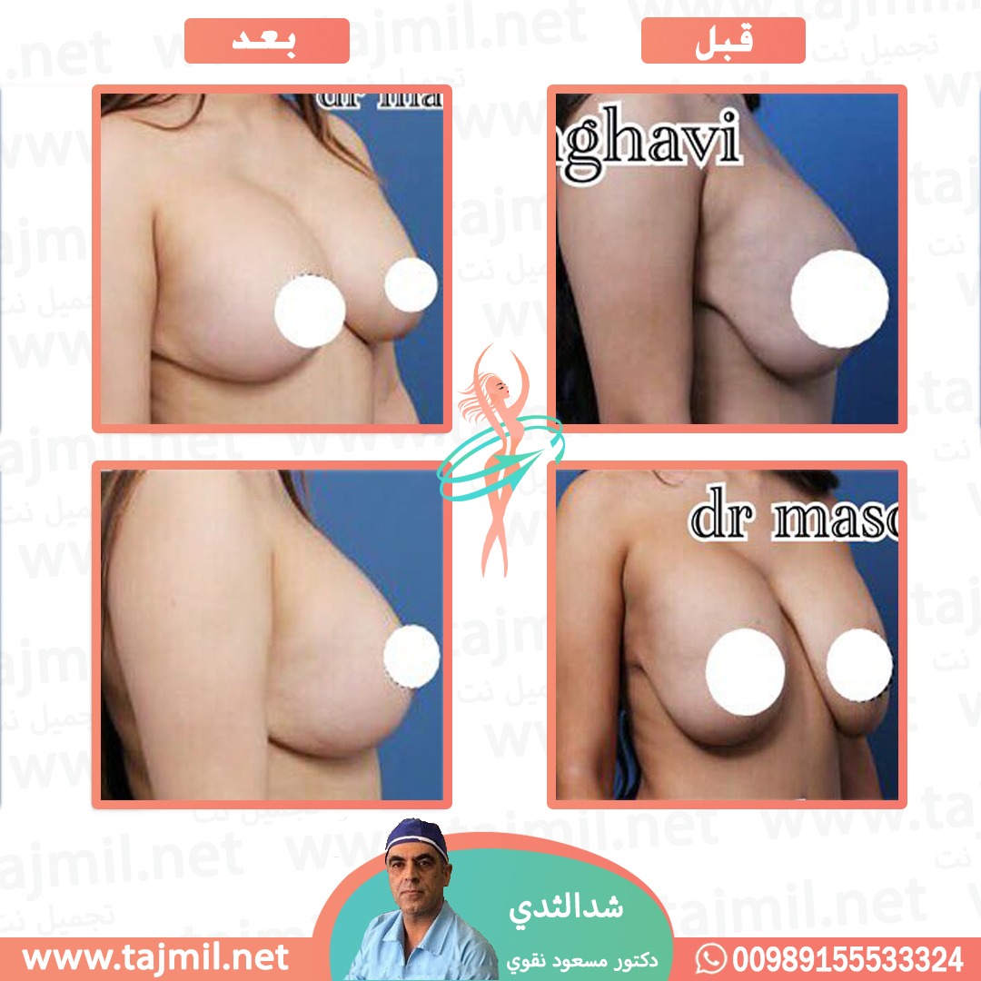  - دکتور مسعود نقوي عملية شد الثدي في ايران مع تجميل نت