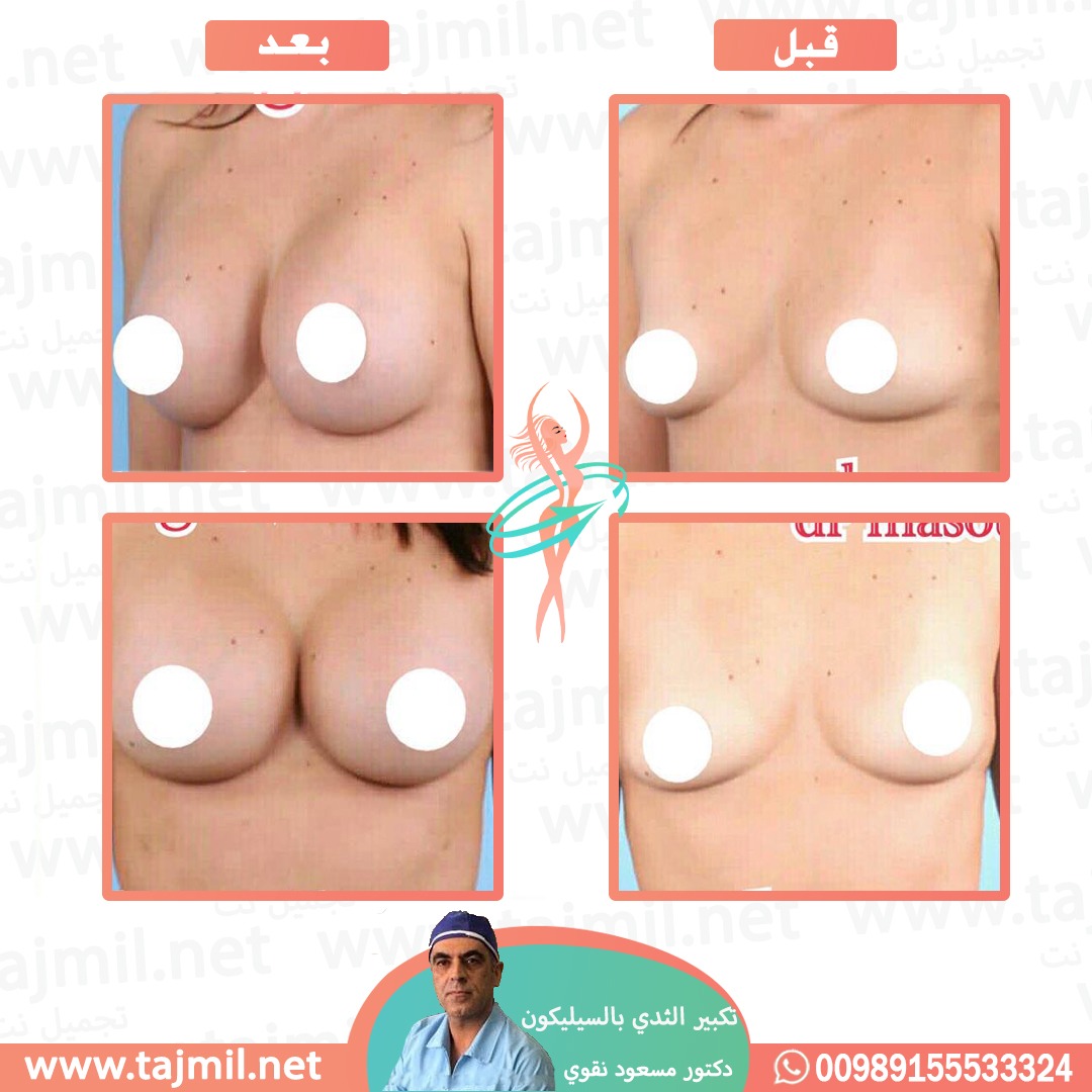  - دکتور مسعود نقوي عملية تکبیر الثدي بالسیلیکون في ايران مع تجميل نت