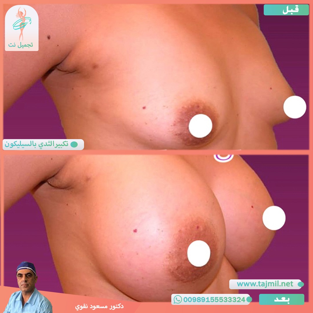  - دکتور مسعود نقوي عملية تکبیر الثدي بالسیلیکون في ايران مع تجميل نت