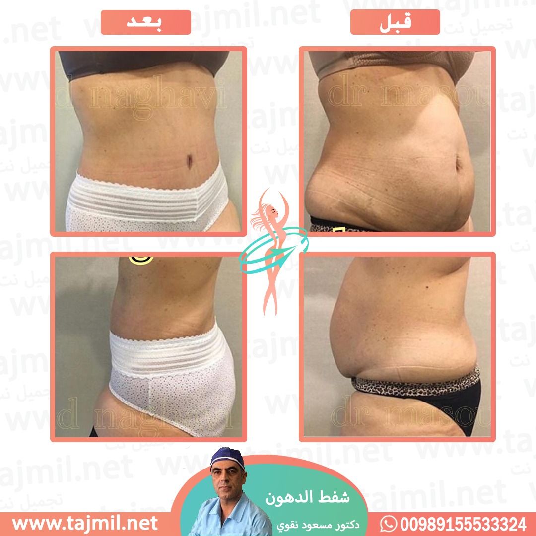  - دکتور مسعود نقوي عملية شفط الدهون في ايران مع تجميل نت