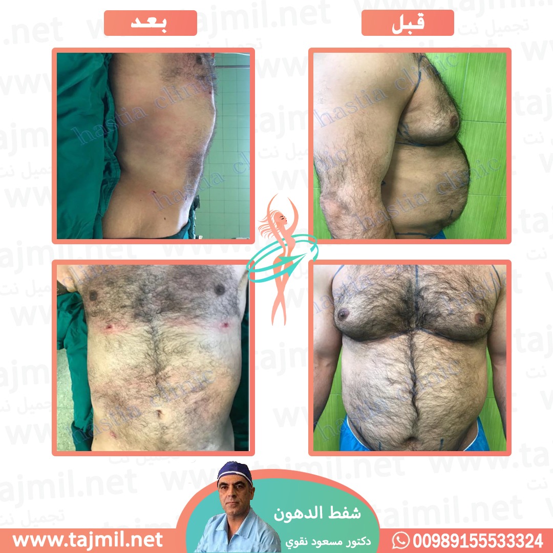  - دکتور مسعود نقوي عملية شفط الدهون في ايران مع تجميل نت