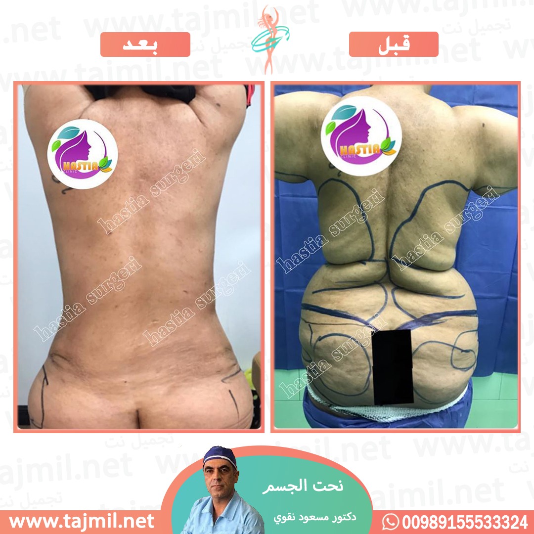  - دکتور مسعود نقوي عملية نحت الجسم في ايران مع تجميل نت