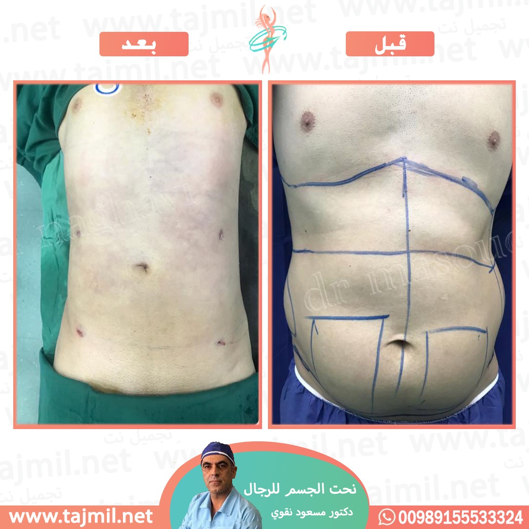  - دکتور مسعود نقوي عملية نحت الجسم للرجال في ايران مع تجميل نت