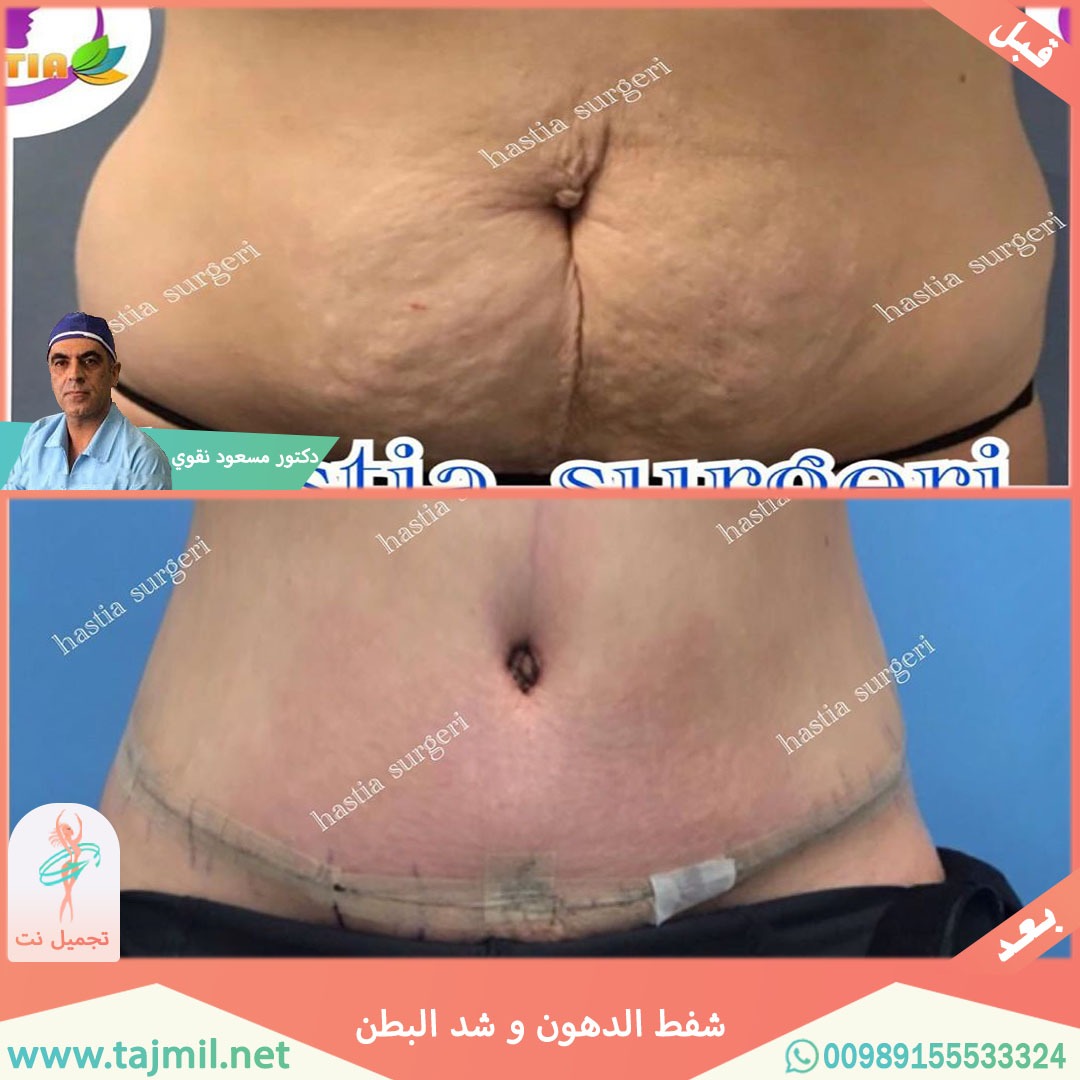  - دکتور مسعود نقوي عملیة شفط الدهون و شد البطن في ایران مع تجمیل نت