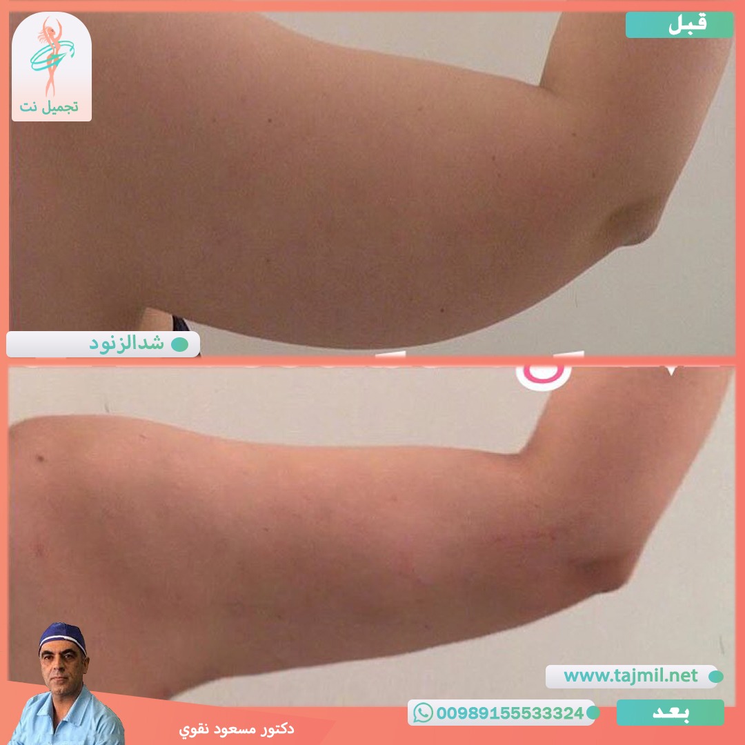  - دکتور مسعود نقوي عملية شد الزنود في ايران مع تجميل نت