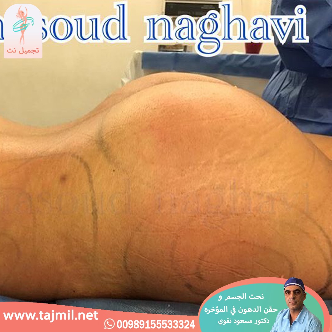  - دکتور مسعود نقوي عملیة نحت الجسم و حقن الدهون في المؤخره في ایران مع تجمیل نت