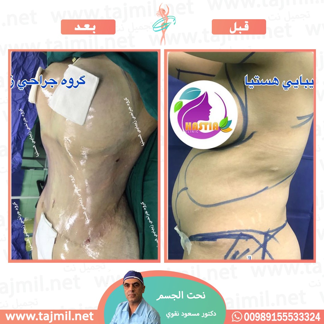  - دکتور مسعود نقوي عملية نحت الجسم في ايران مع تجميل نت