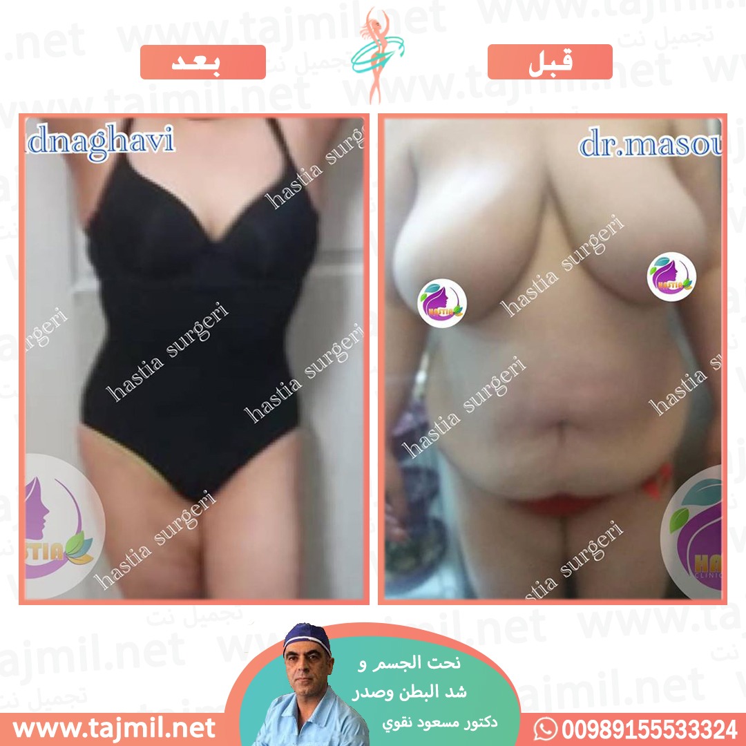  - دکتور مسعود نقوي عملیة نحت الجسم و شد البطن و صدر في ایران مع تجمیل نت