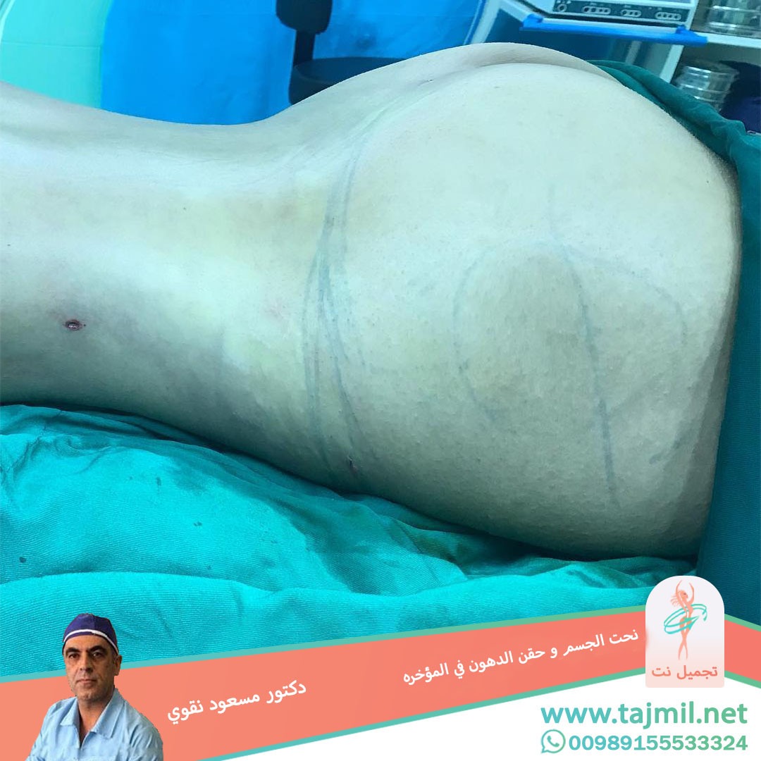  - دکتور مسعود نقوي عملیة نحت الجسم و حقن الدهون في المؤخره في ایران مع تجمیل نت