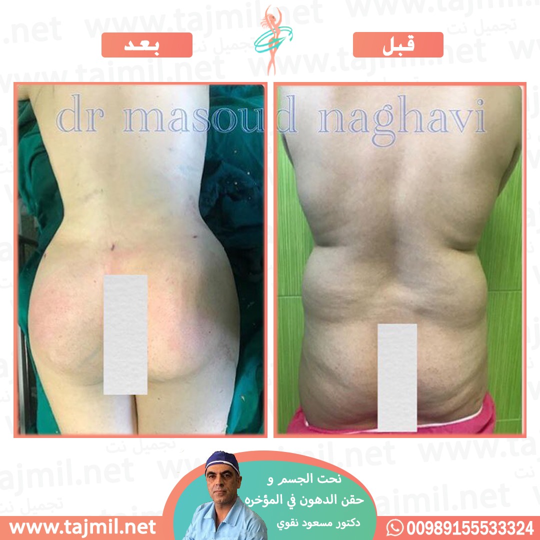  - دکتور مسعود نقوي عملیة نحت الجسم و حقن الدهون في المؤخره في ایران مع تجمیل نت