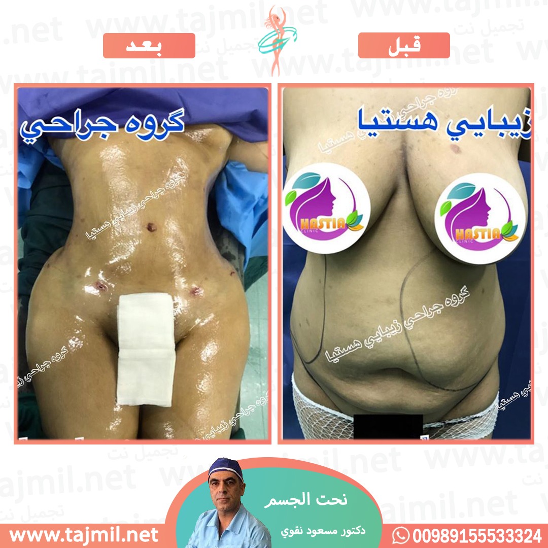  - دکتور مسعود نقوي عملية نحت الجسم في ايران مع تجميل نت