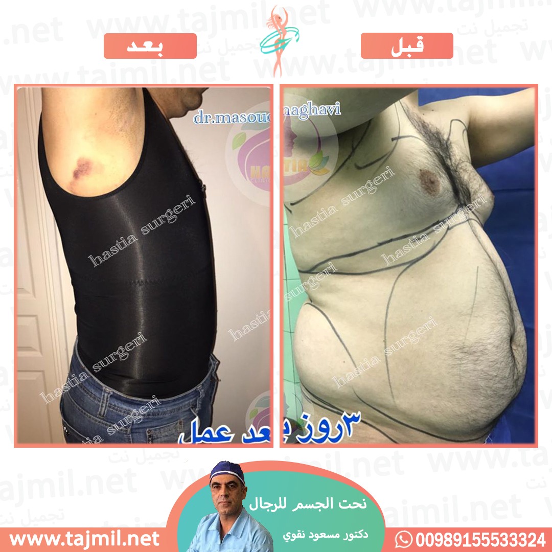  - دکتور مسعود نقوي عملية نحت الجسم للرجال في ايران مع تجميل نت