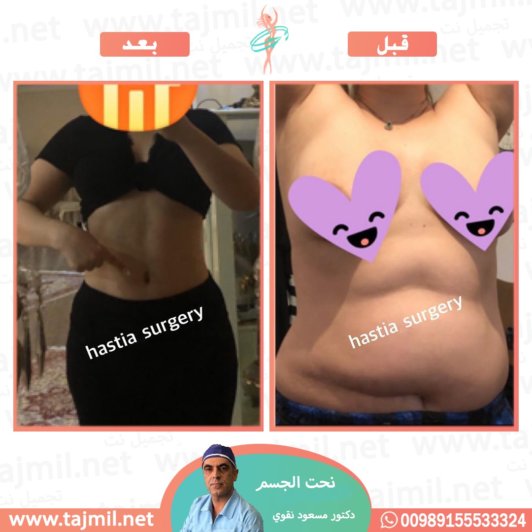  - دکتور مسعود نقوي عملية نحت الجسم في ايران مع تجميل نت