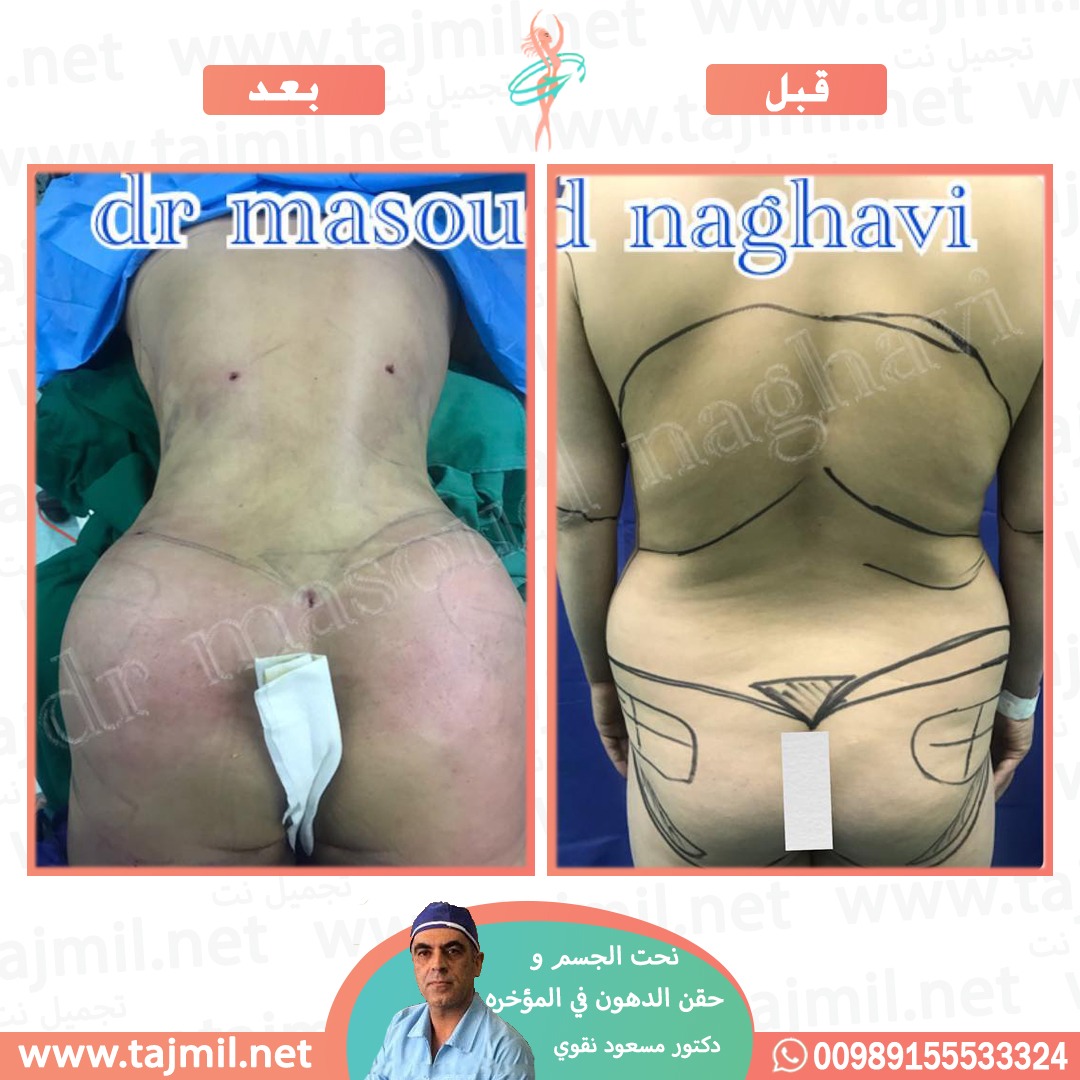  - دکتور مسعود نقوي عملیة نحت الجسم و حقن الدهون في المؤخره في ایران مع تجمیل نت