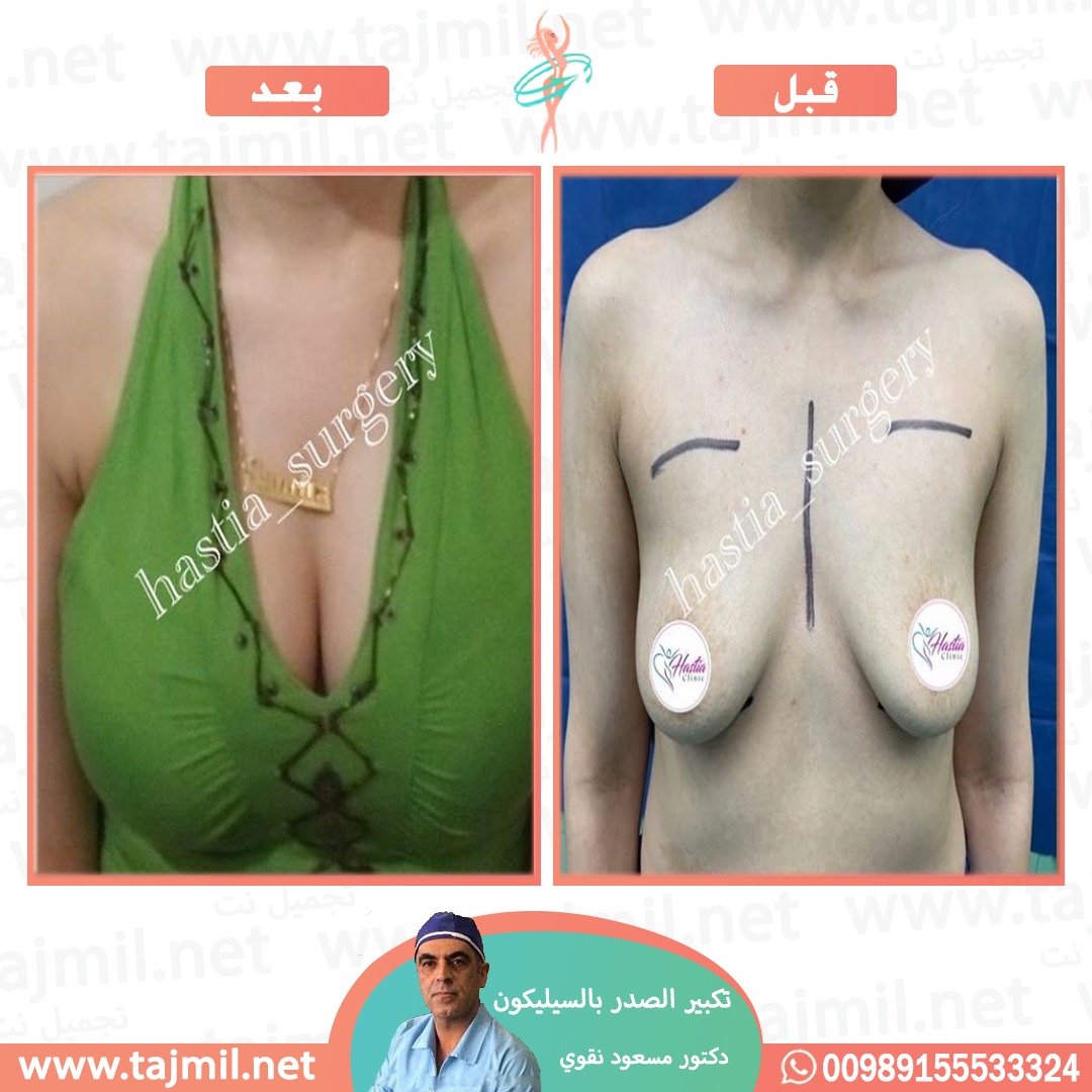  - دکتور مسعود نقوي عملية تکبیر الصدر بالسیلیکون في ايران مع تجميل نت