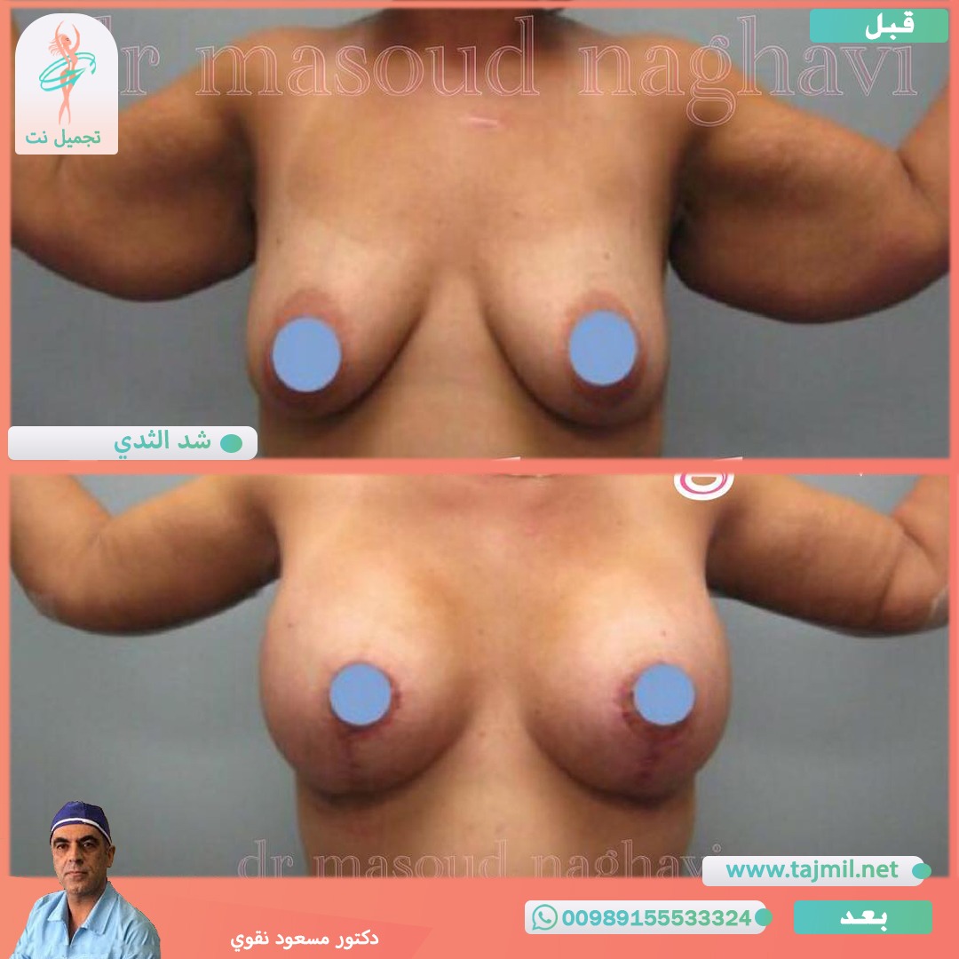  - دکتور مسعود نقوي عملية شد الثدي في ايران مع تجميل نت