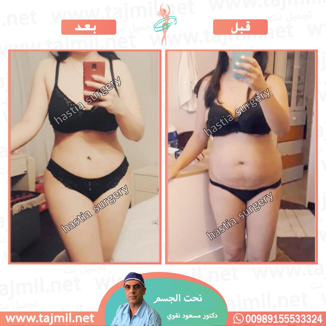  - دکتور مسعود نقوي عملية نحت الجسم في ايران مع تجميل نت