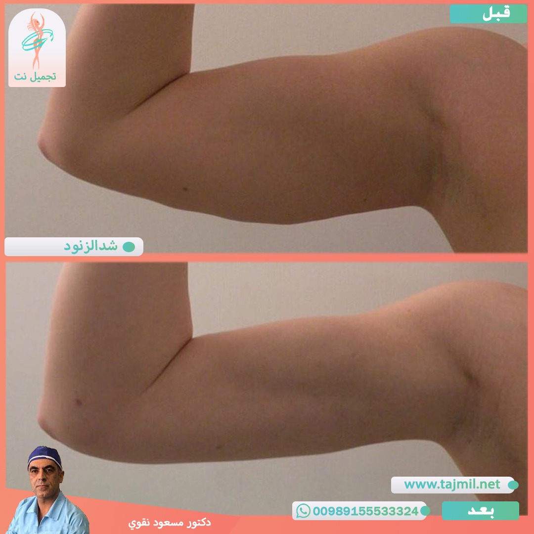  - دکتور مسعود نقوي عملية شد الزنود في ايران مع تجميل نت