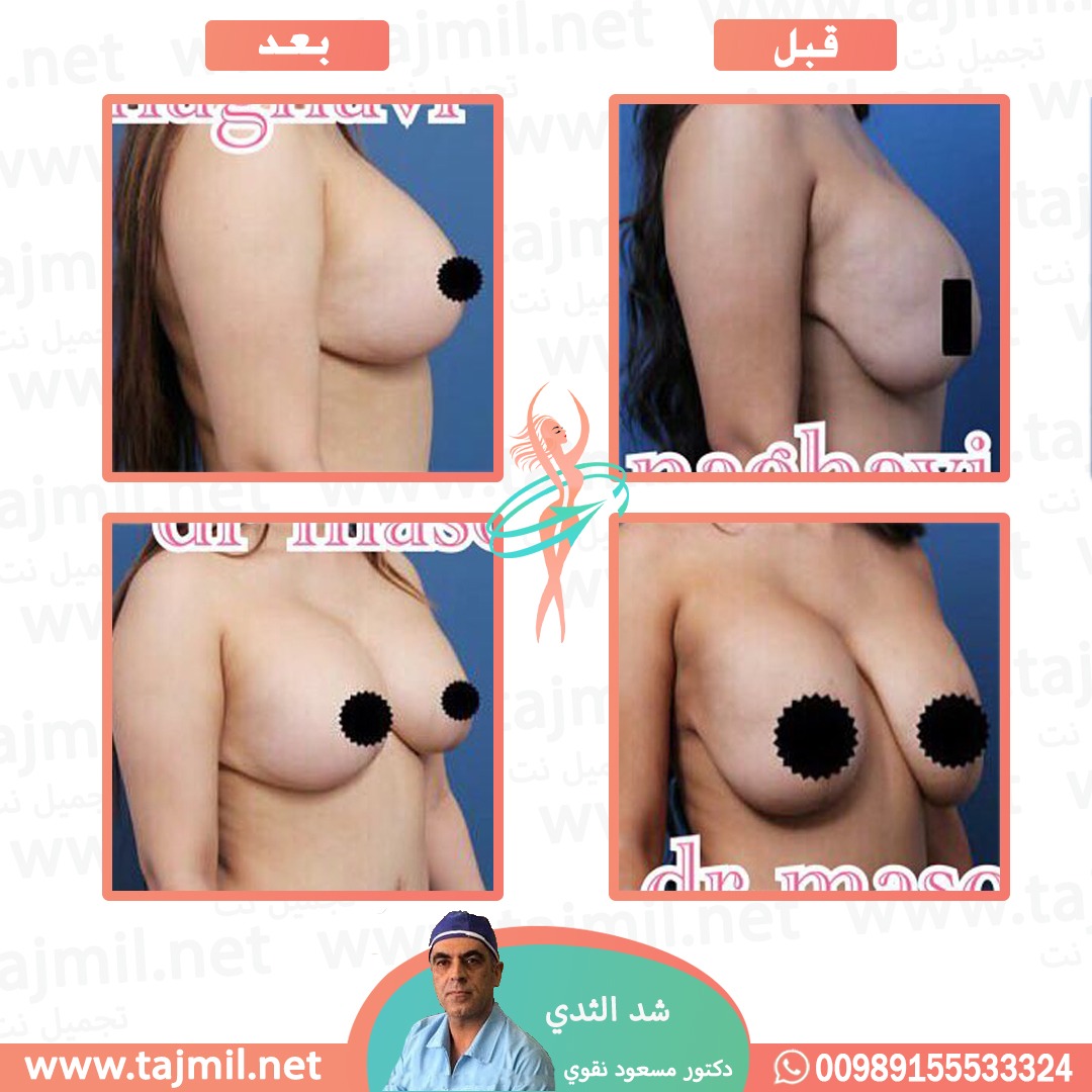  - دکتور مسعود نقوي عملية شد الثدي في ايران مع تجميل نت