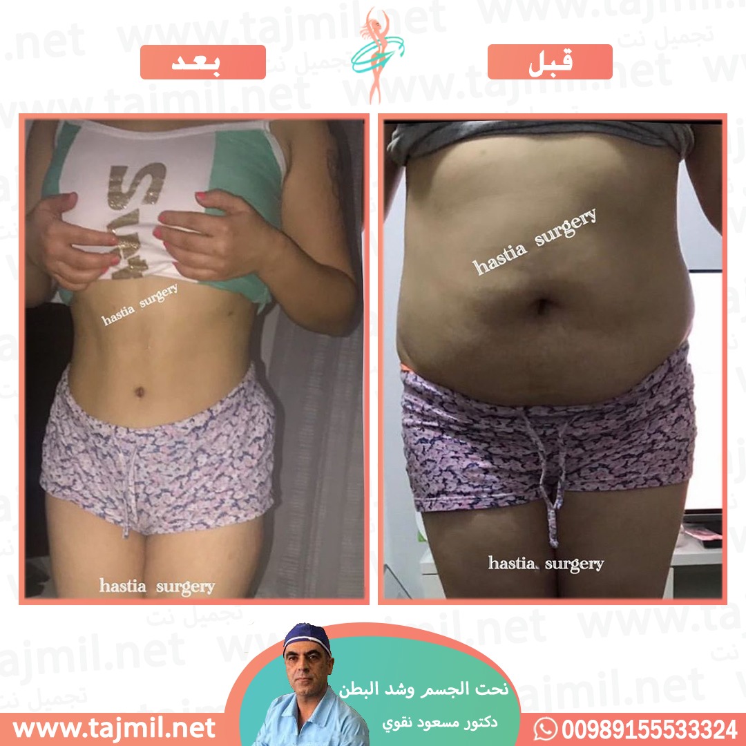  - دکتور مسعود نقوي عملية نحت الجسم و شد البطن في ايران مع تجميل نت