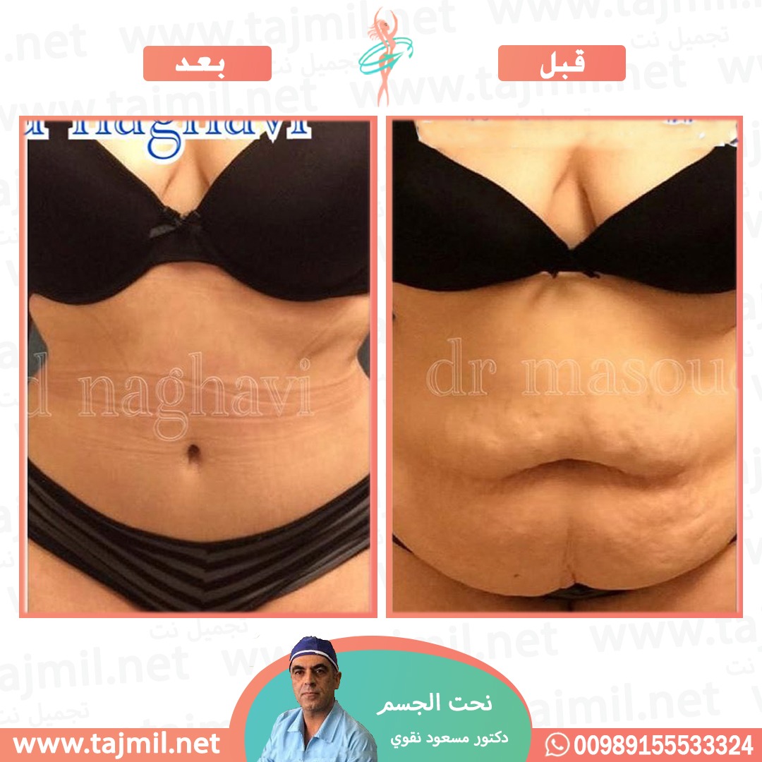  - دکتور مسعود نقوي عملية نحت الجسم في ايران مع تجميل نت