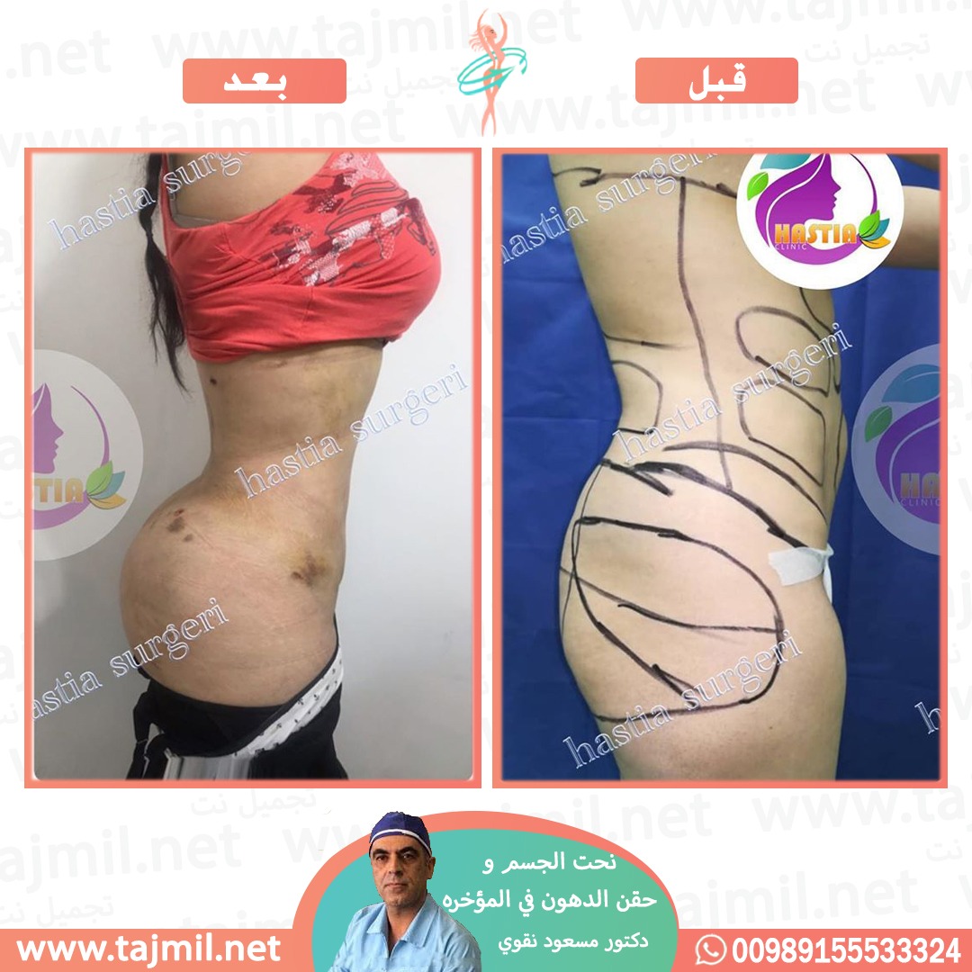  - دکتور مسعود نقوي عملیة نحت الجسم و حقن الدهون في المؤخره في ایران مع تجمیل نت