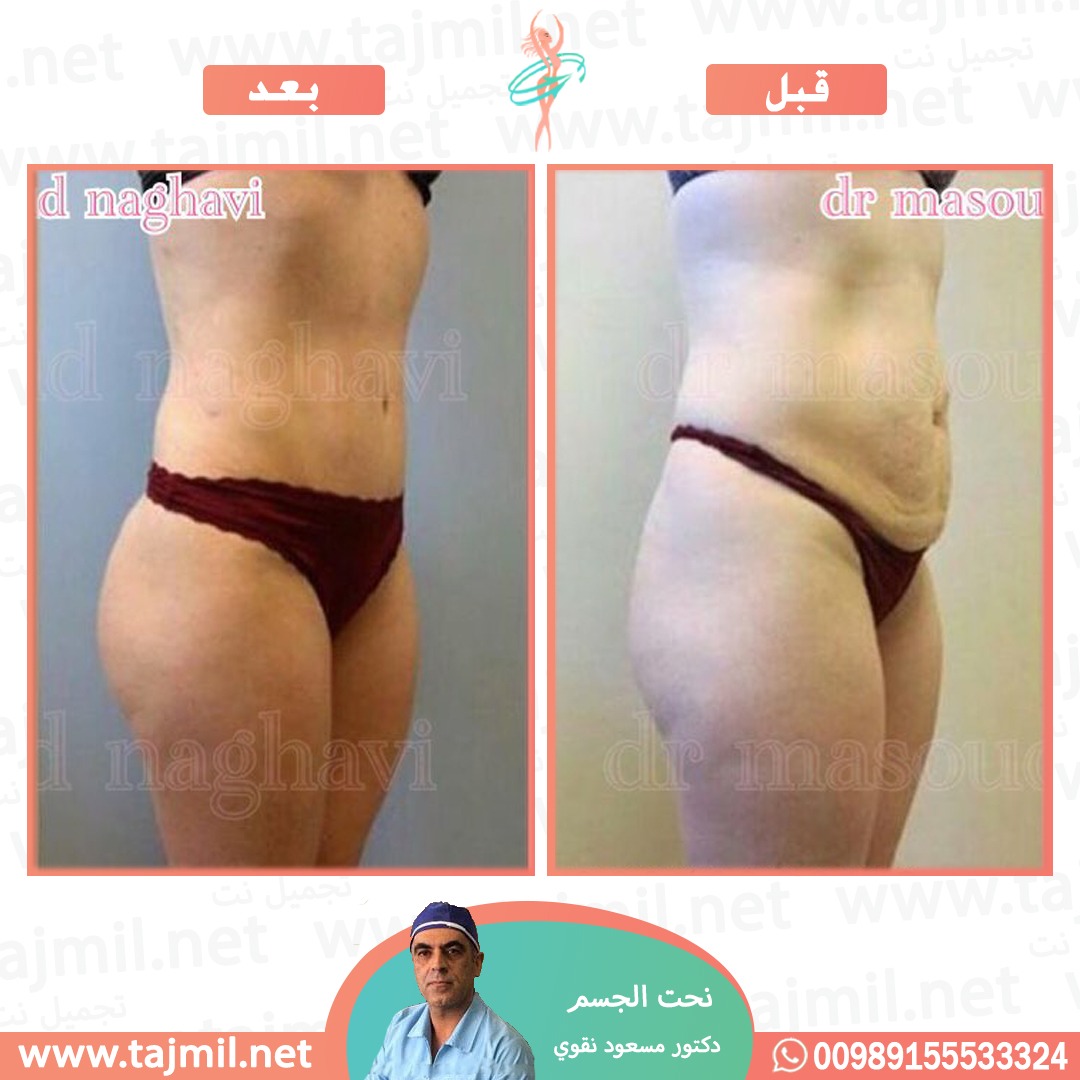  - دکتور مسعود نقوي عملية نحت الجسم في ايران مع تجميل نت