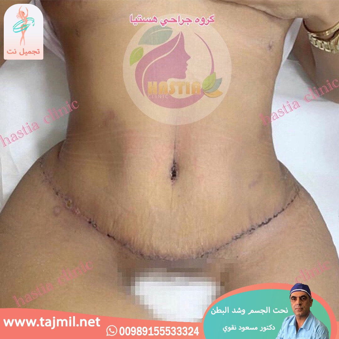  - دکتور مسعود نقوي عملية نحت الجسم و شد البطن في ايران مع تجميل نت