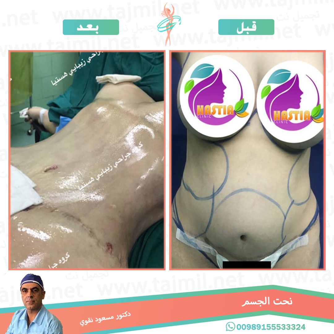  - دکتور مسعود نقوي عملية نحت الجسم في ايران مع تجميل نت