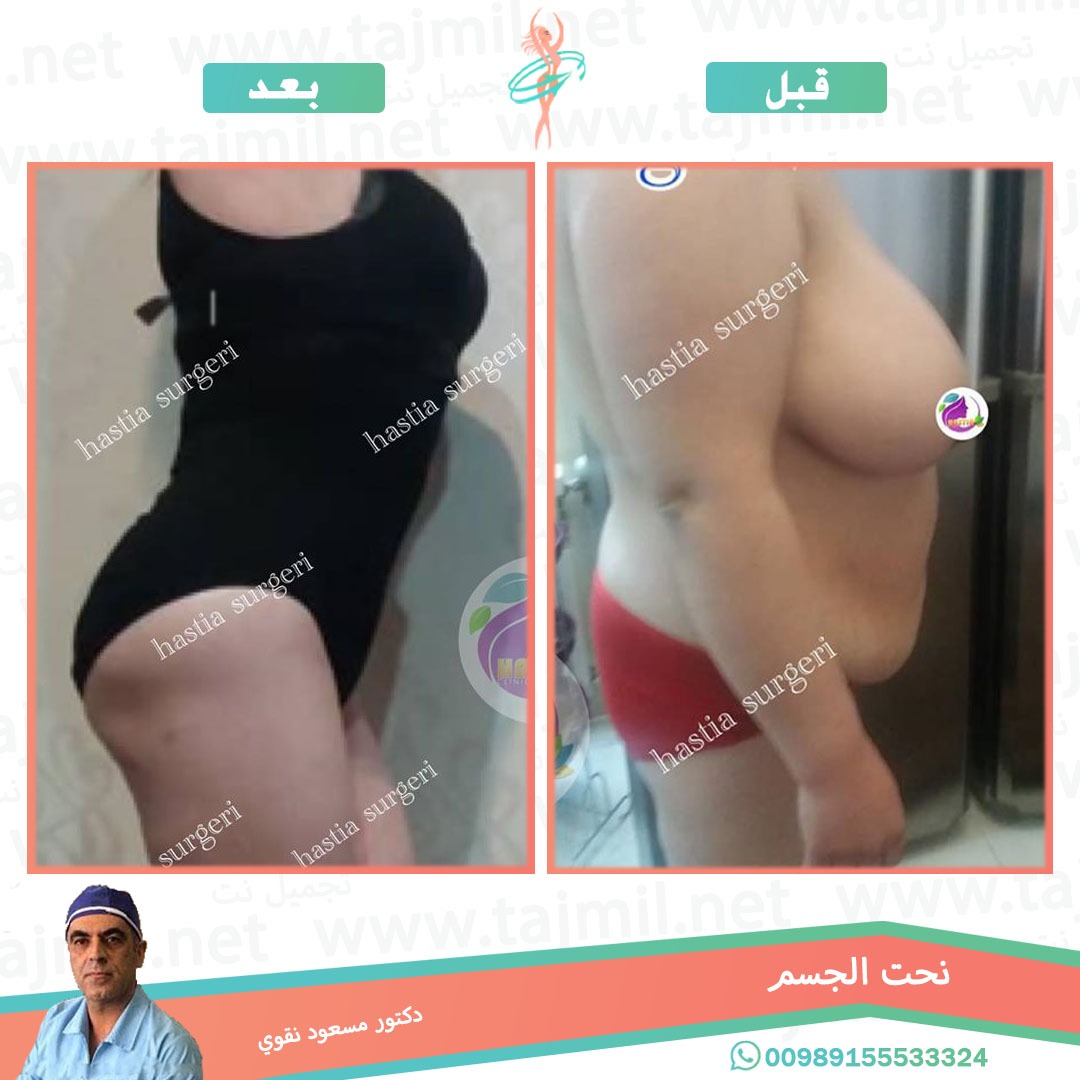  - دکتور مسعود نقوي عملية نحت الجسم في ايران مع تجميل نت