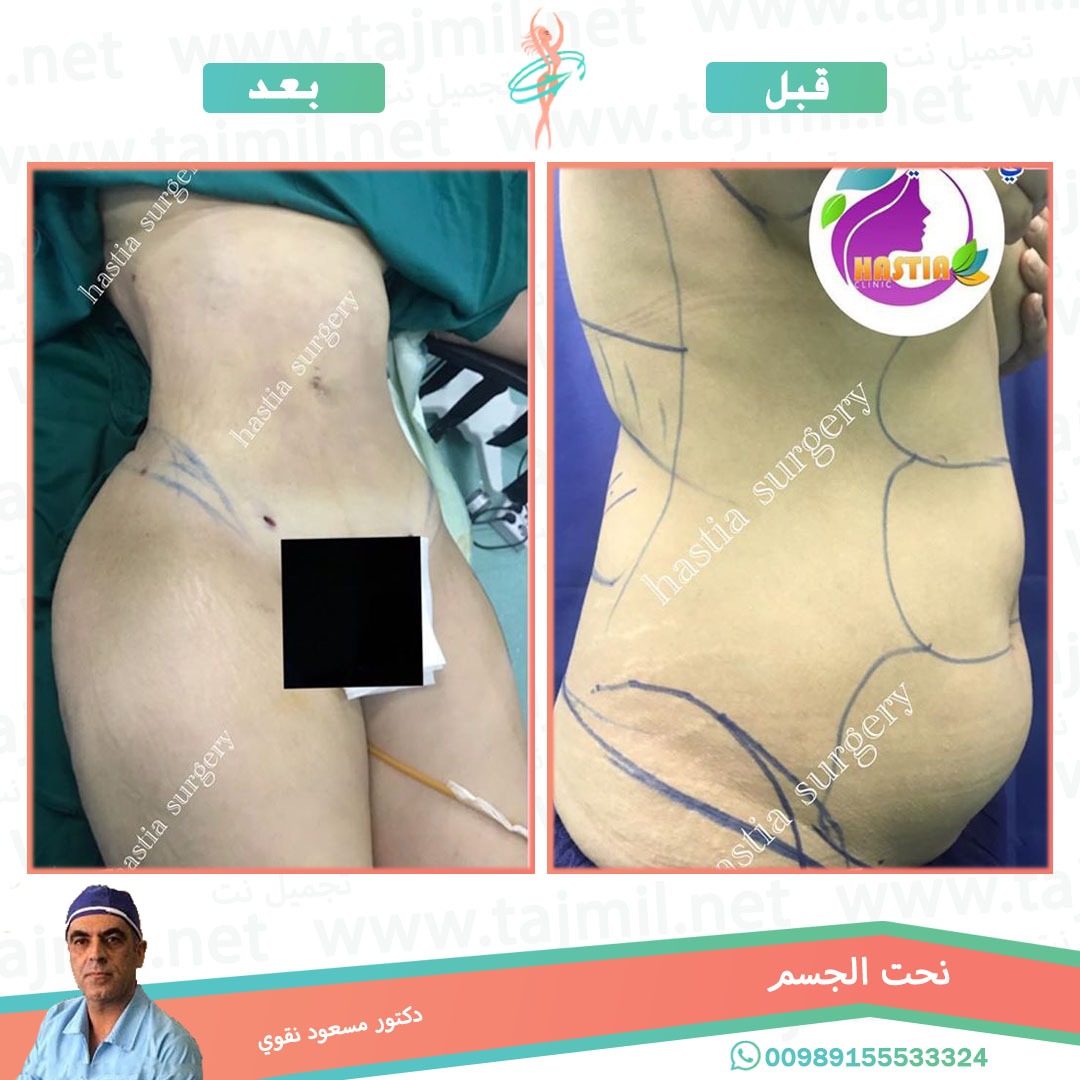  - دکتور مسعود نقوي عملية نحت الجسم في ايران مع تجميل نت