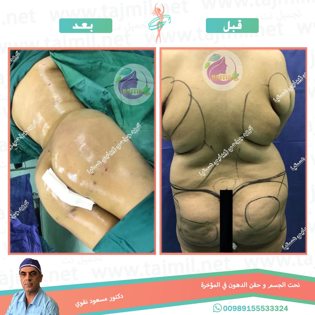  - دکتور مسعود نقوي عملیة نحت الجسم و حقن الدهون في المؤخره في ایران مع تجمیل نت