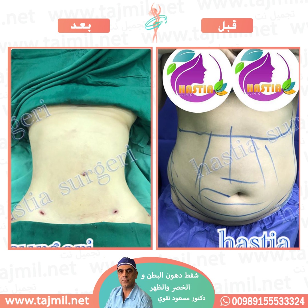  - دکتور مسعود نقوي عملیة شفط دهون البطن و الخصر و الظهر   في ایران مع تجمیل نت