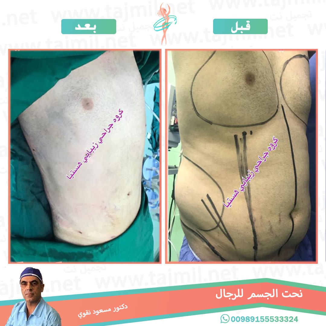  - دکتور مسعود نقوي عملية نحت الجسم للرجال في ايران مع تجميل نت