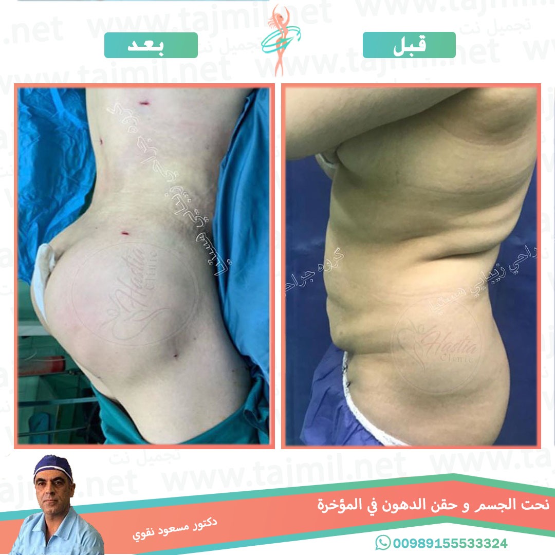  - دکتور مسعود نقوي عملیة نحت الجسم و حقن الدهون في المؤخره في ایران مع تجمیل نت