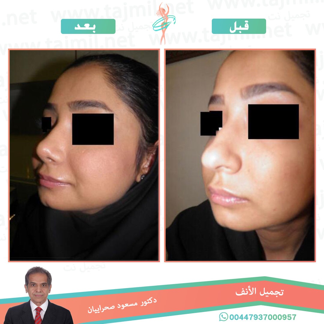  - دکتور مهدي بخشایي عملية تجميل الانف في ايران مع تجميل نت