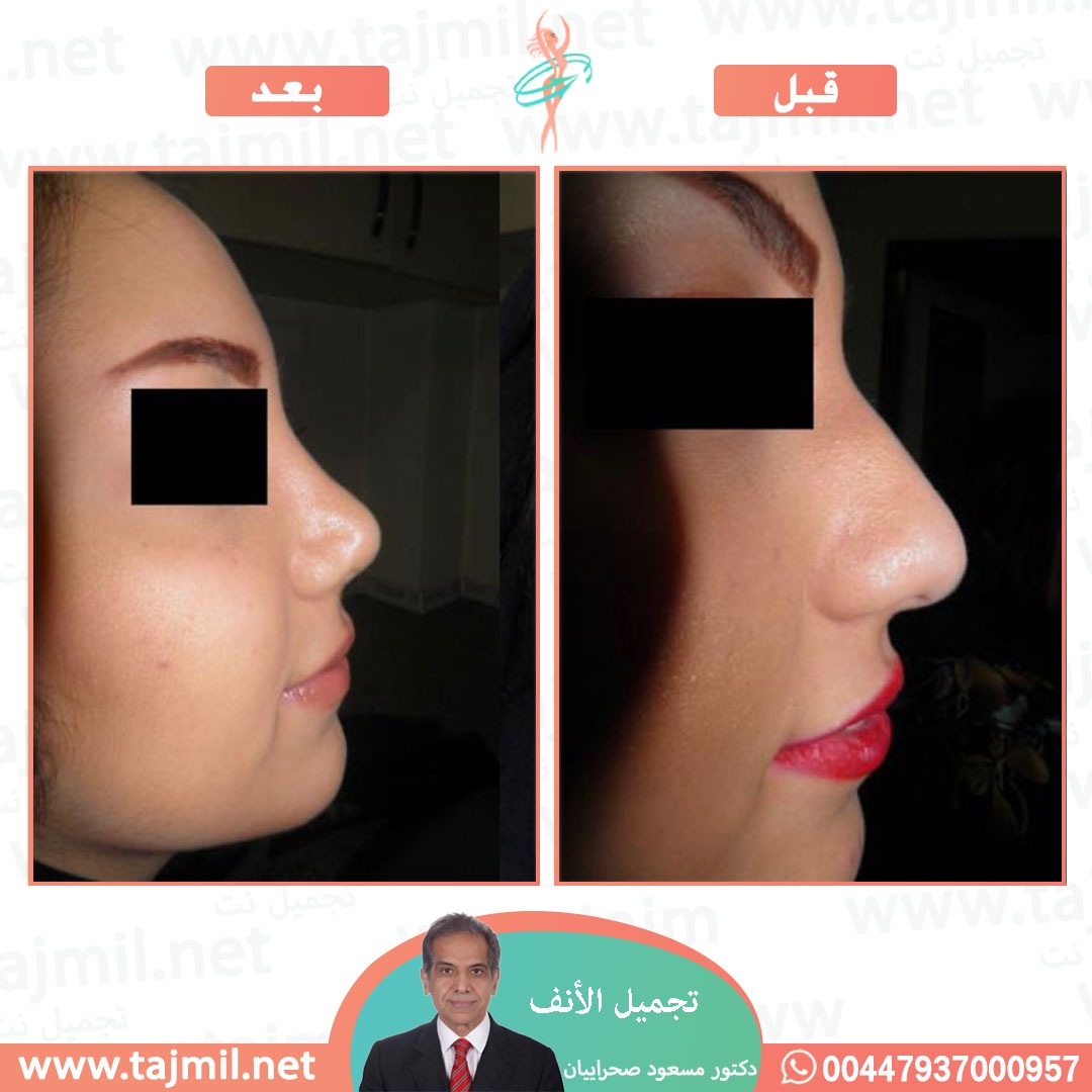  - دکتور مهدي بخشایي عملية تجميل الانف في ايران مع تجميل نت