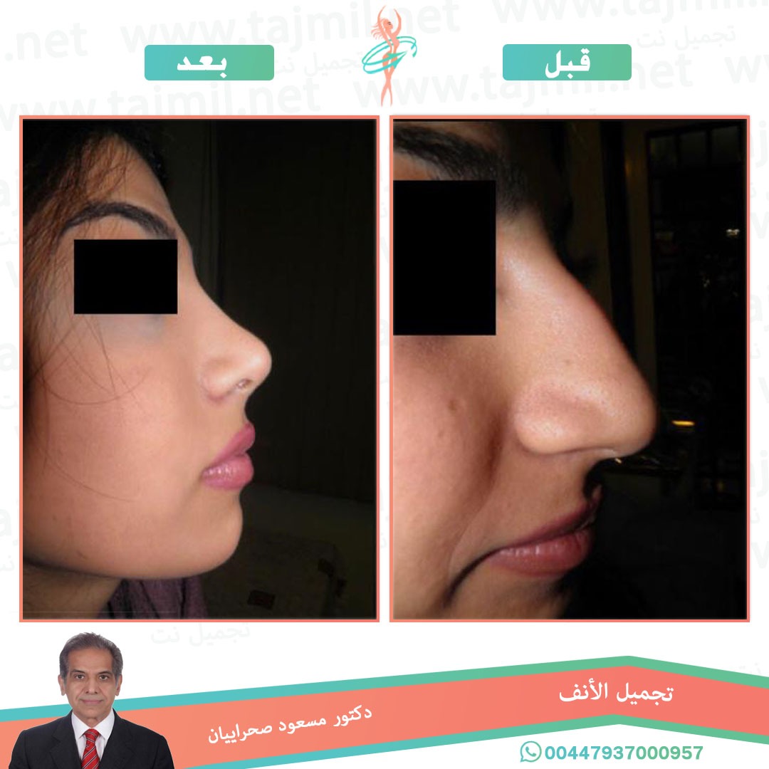  - دکتور مهدي بخشایي عملية تجميل الانف في ايران مع تجميل نت