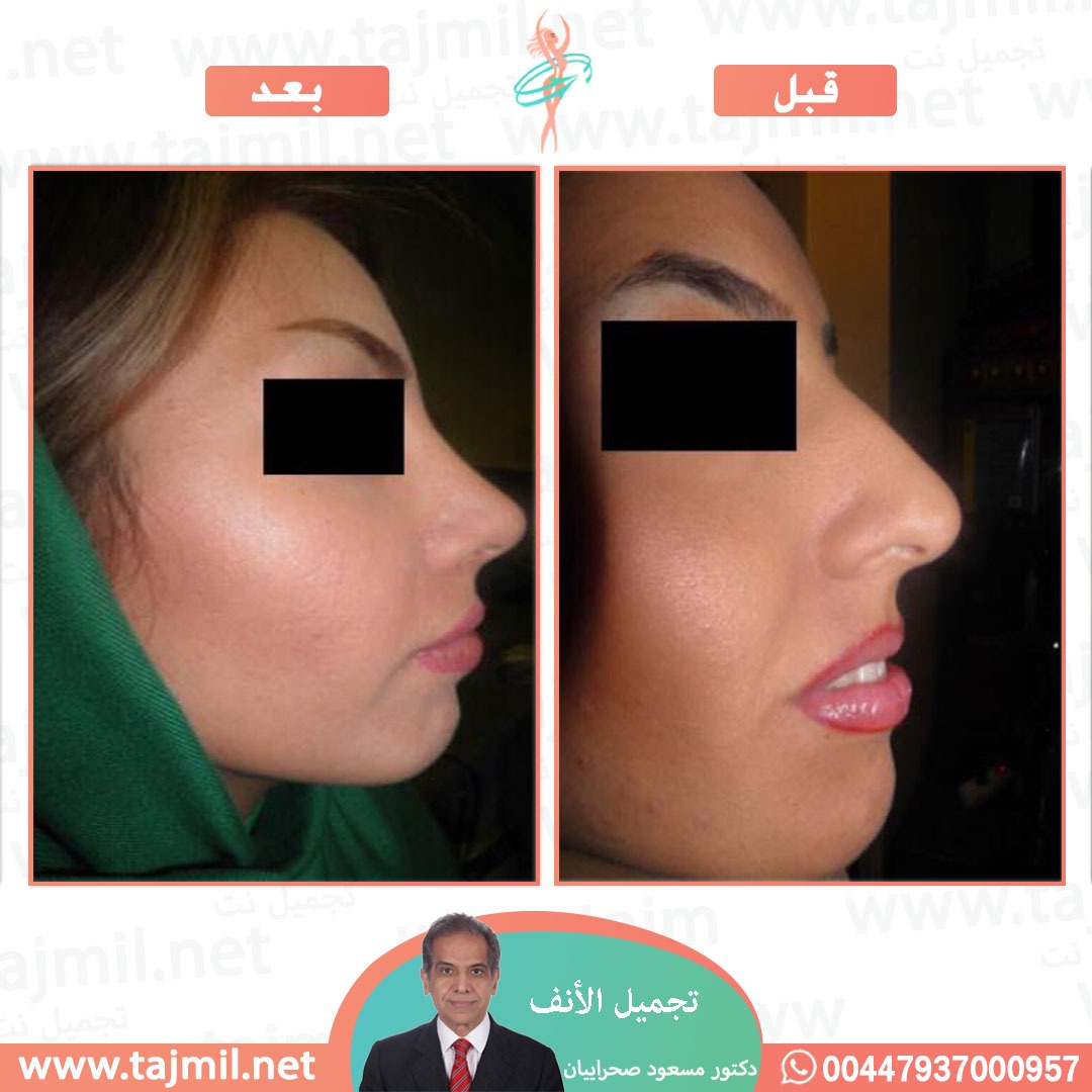  - دکتور مهدي بخشایي عملية تجميل الانف في ايران مع تجميل نت