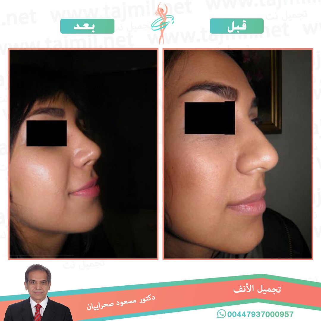  - دکتور مهدي بخشایي عملية تجميل الانف في ايران مع تجميل نت