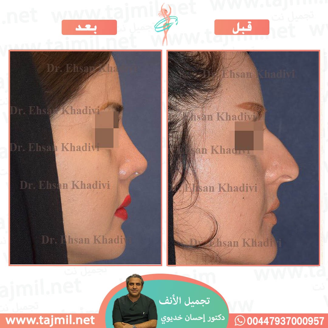  - دکتور إحسان خدیوي عملية تجميل الانف في ايران مع تجميل نت