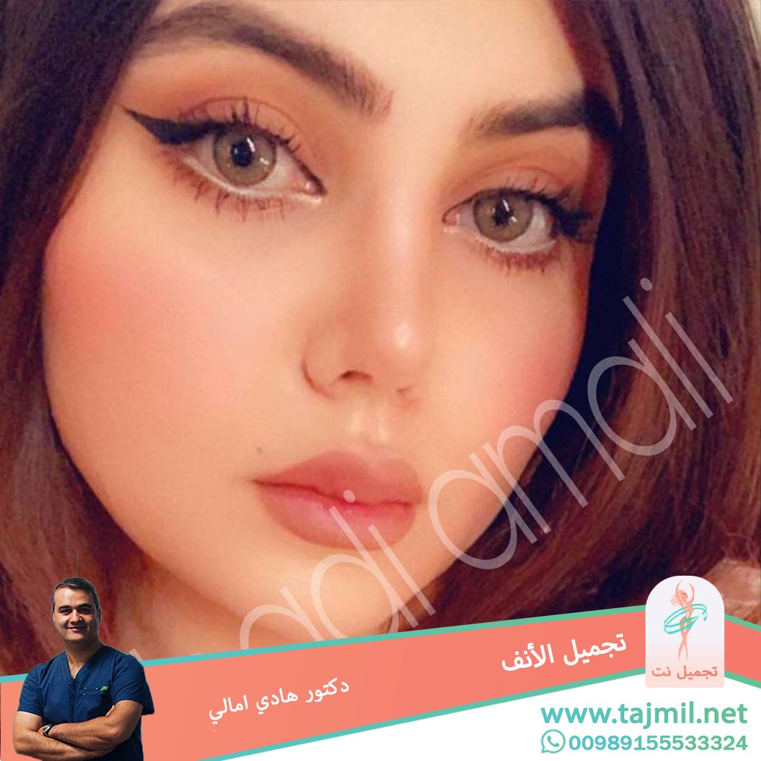  - دکتور هادي امالي عملية تجميل الأنف في ايران مع تجميل نت