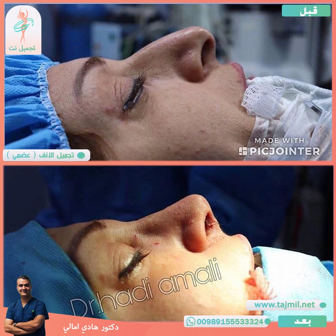  - دکتور هادي امالي عملية تجميل الأنف في ايران مع تجميل نت