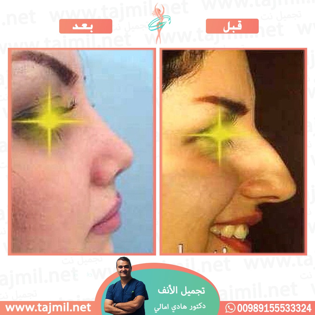  - دکتور هادي امالي عملية تجميل الأنف في ايران مع تجميل نت