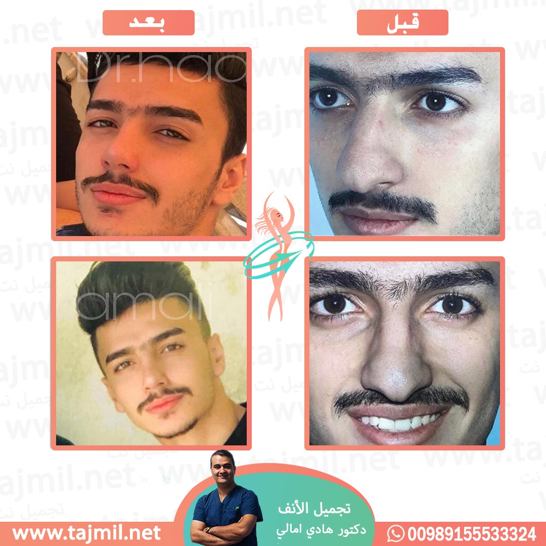  - دکتور هادي امالي عملية تجميل الأنف في ايران مع تجميل نت