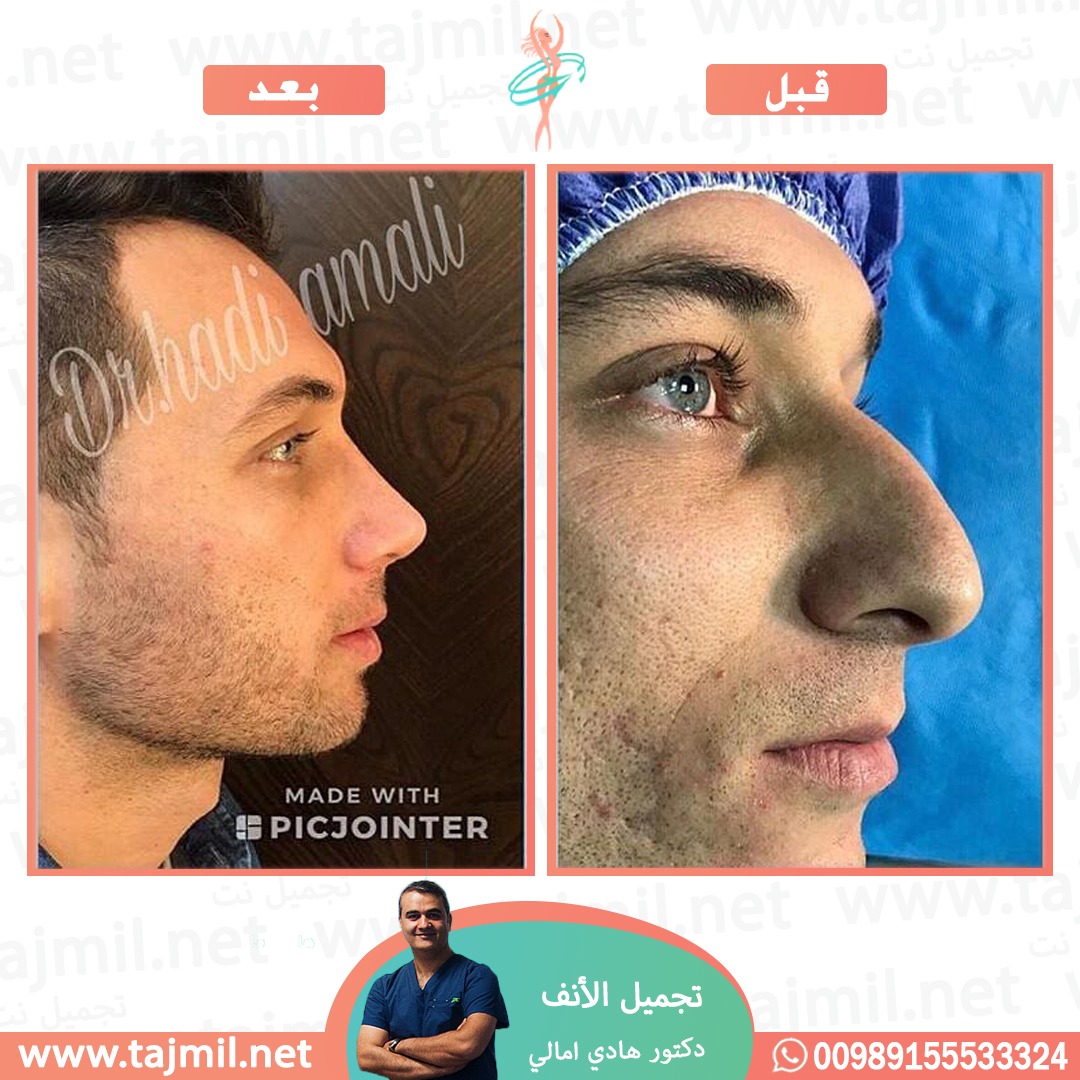  - دکتور هادي امالي عملية تجميل الأنف في ايران مع تجميل نت