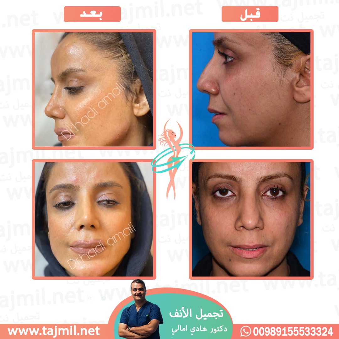  - دکتور هادي امالي عملية تجميل الأنف في ايران مع تجميل نت